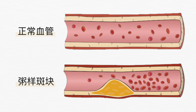 血栓是心梗、腦梗的元兇，很容易找上這些人