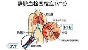 腎病綜合癥的VTE預(yù)防