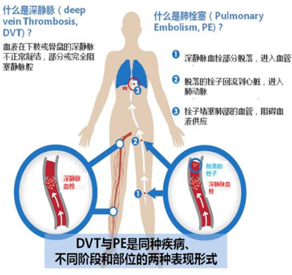 腫瘤患者VTE的預(yù)防