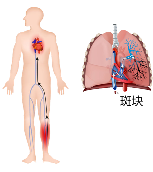 血栓是心梗、腦梗的元兇，很容易找上這些人