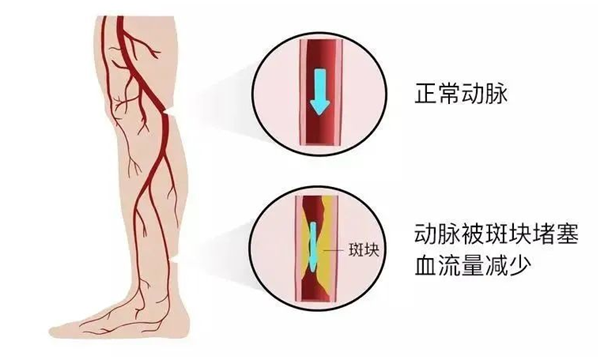 血栓是心梗、腦梗的元兇，很容易找上這些人