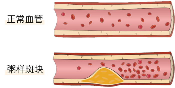 血栓是心梗、腦梗的元兇，很容易找上這些人