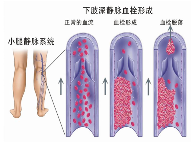 警惕！這個全球“第三大心血管殺手”，我們該如何應對？