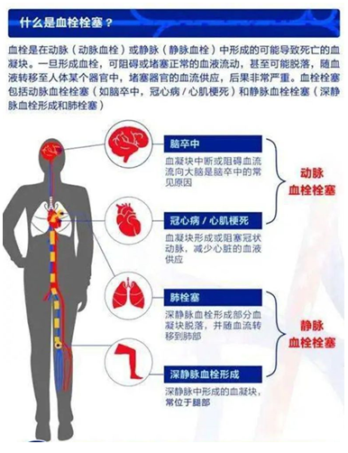2022世界血栓日：就醫(yī)有新路，血栓找介入