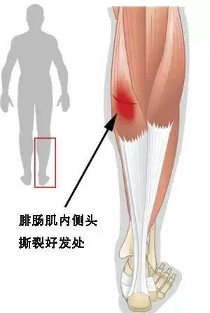 深靜脈血栓類似病癥的認(rèn)識與區(qū)分