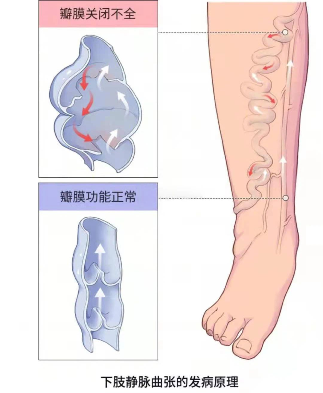 深靜脈血栓類似病癥的認(rèn)識與區(qū)分