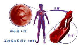 血栓疾病當(dāng)警惕 日常預(yù)防要重視