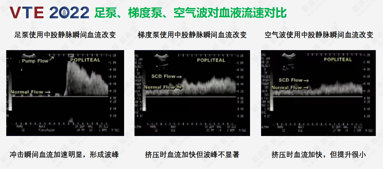 圍術(shù)期患者VTE的預(yù)防，只知道抗凝可不行