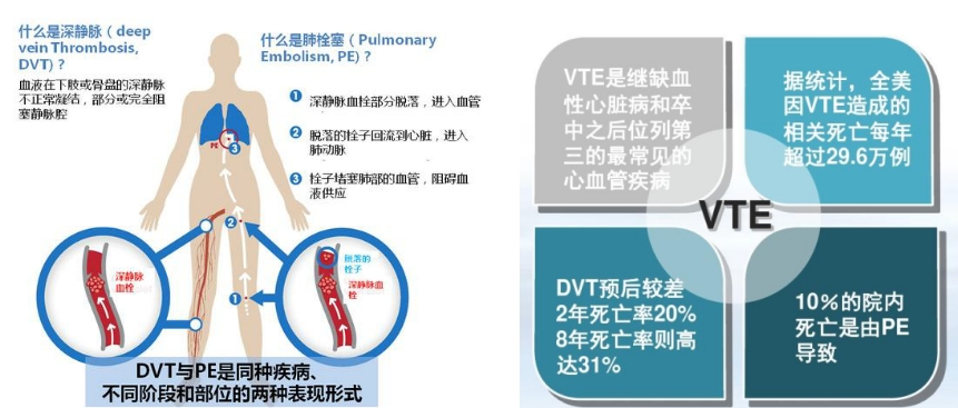 VTE的危害您了解嗎？