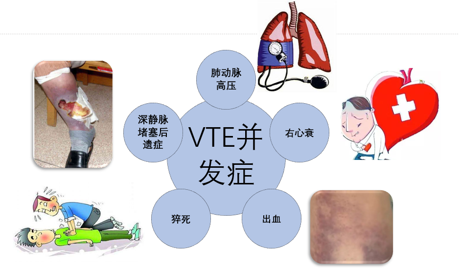 VTE的危害您了解嗎？