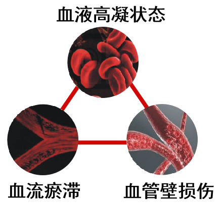 靜脈疾病的患難兄弟