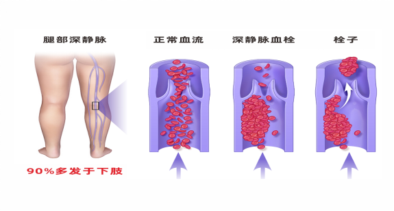 靜脈疾病的患難兄弟