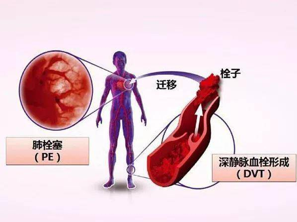 靜脈血栓栓塞癥（VTE）||經(jīng)濟艙綜合癥